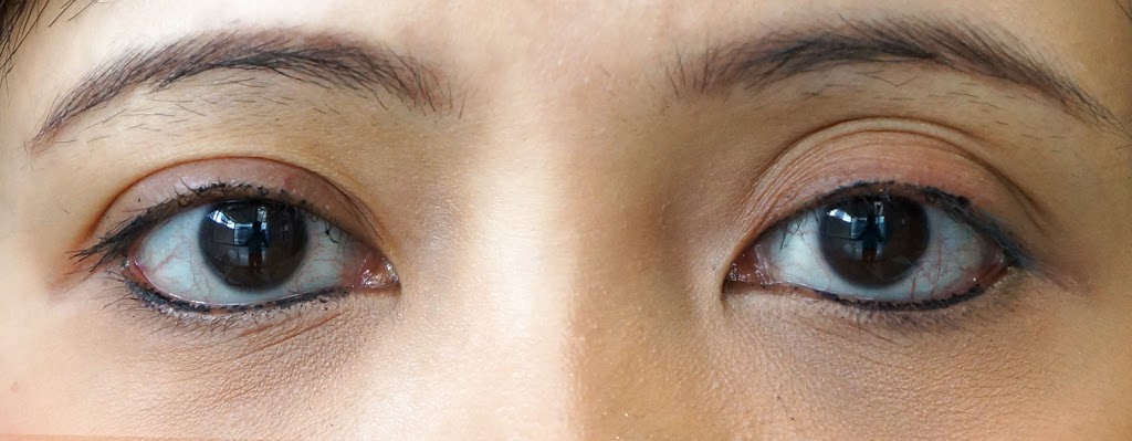 Filler Treatment The Curious Case Of The Triple Eye Lid Dr