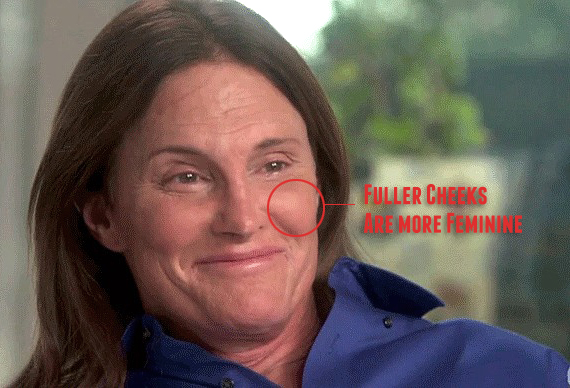 With Fillers, Bruce Jenner had fuller cheeks over the years compared to his younger days. 