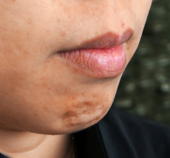 video-walks-you-through-how-to-remove-small-bumps-on-your-chin