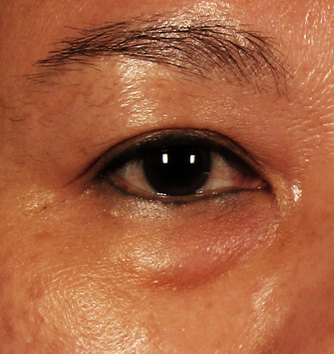 Eye-Bag Filler Dr Siew