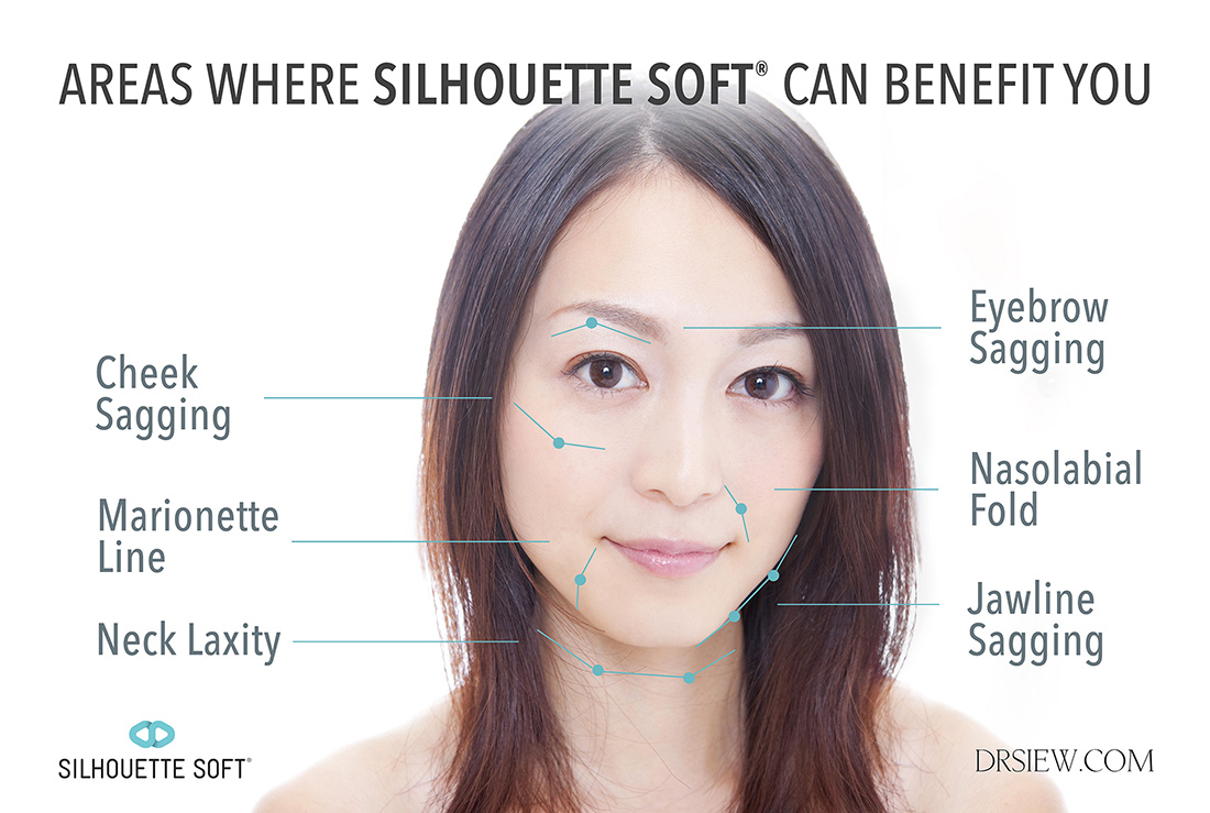 Areas Silhouette Soft benefit Dr Siew