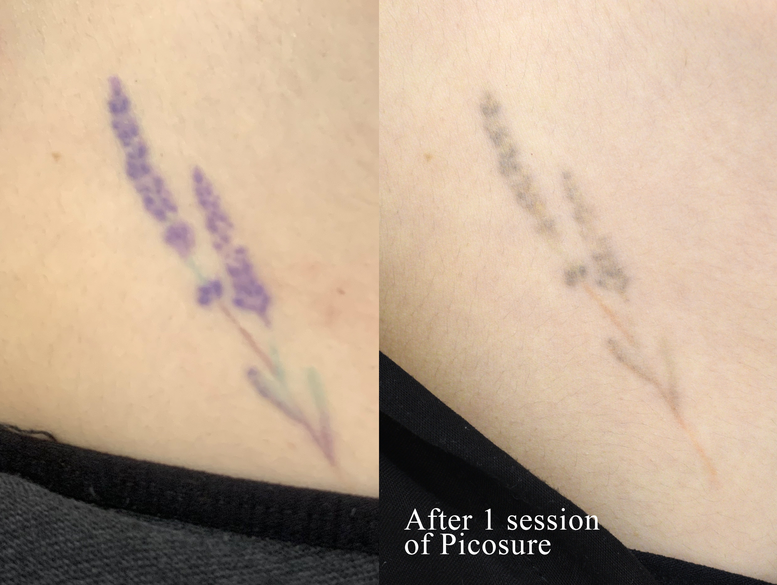 Yorkshire Laser Tattoo Removal