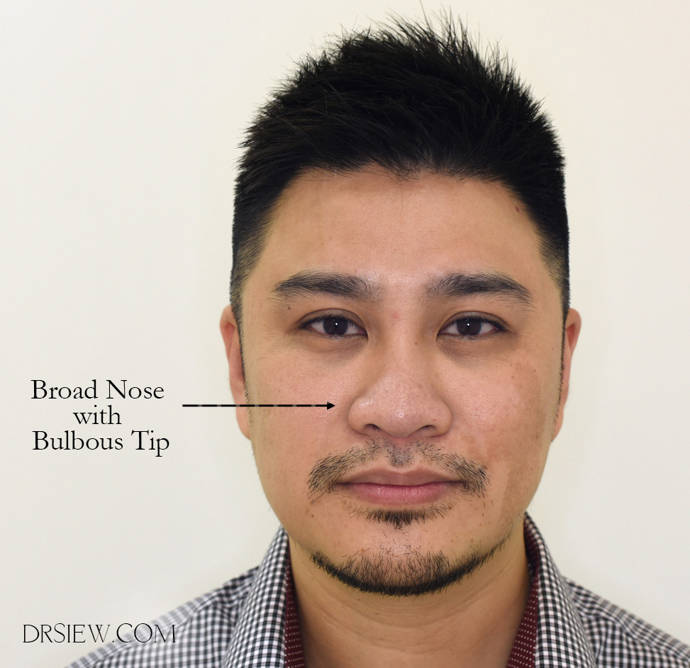 Dr Siew Broad Nose Everything you need to know Fillers