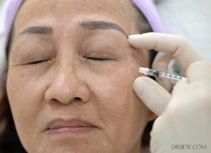 Dr Siew Xeomin Botox Dysport procedure
