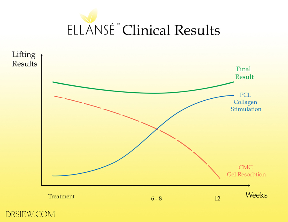 Ellanse Clinical Results Dr Siew.com