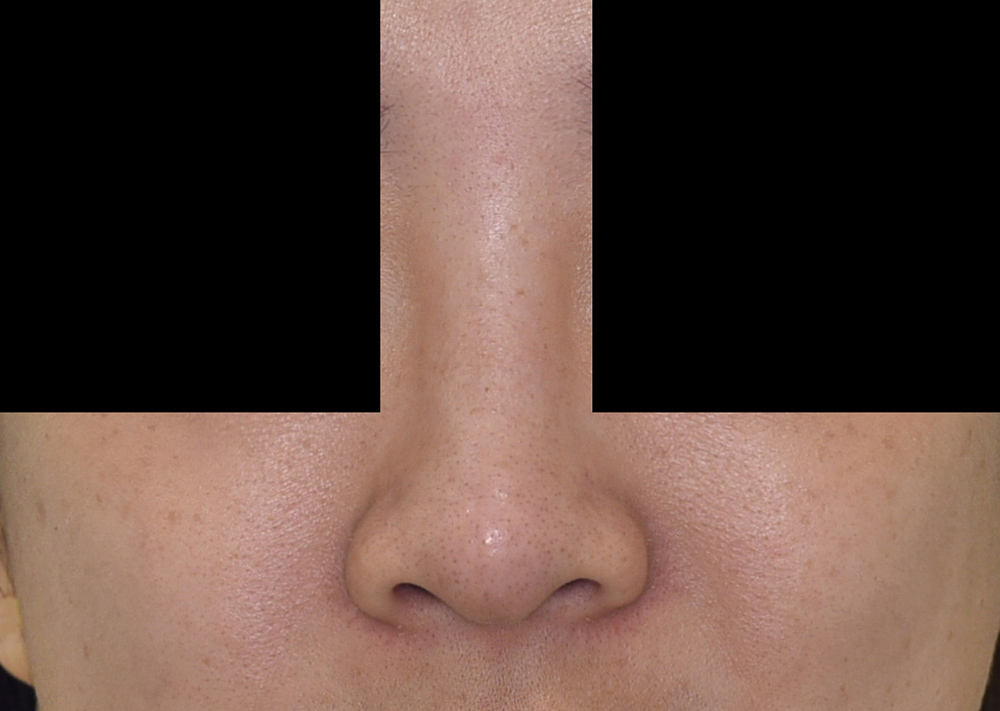 Dermal Filler Nose complications Dr Siew