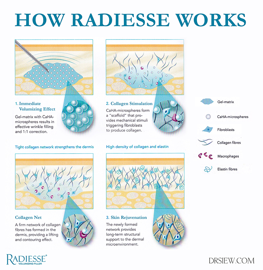 How Radiesse Works Dr Siew