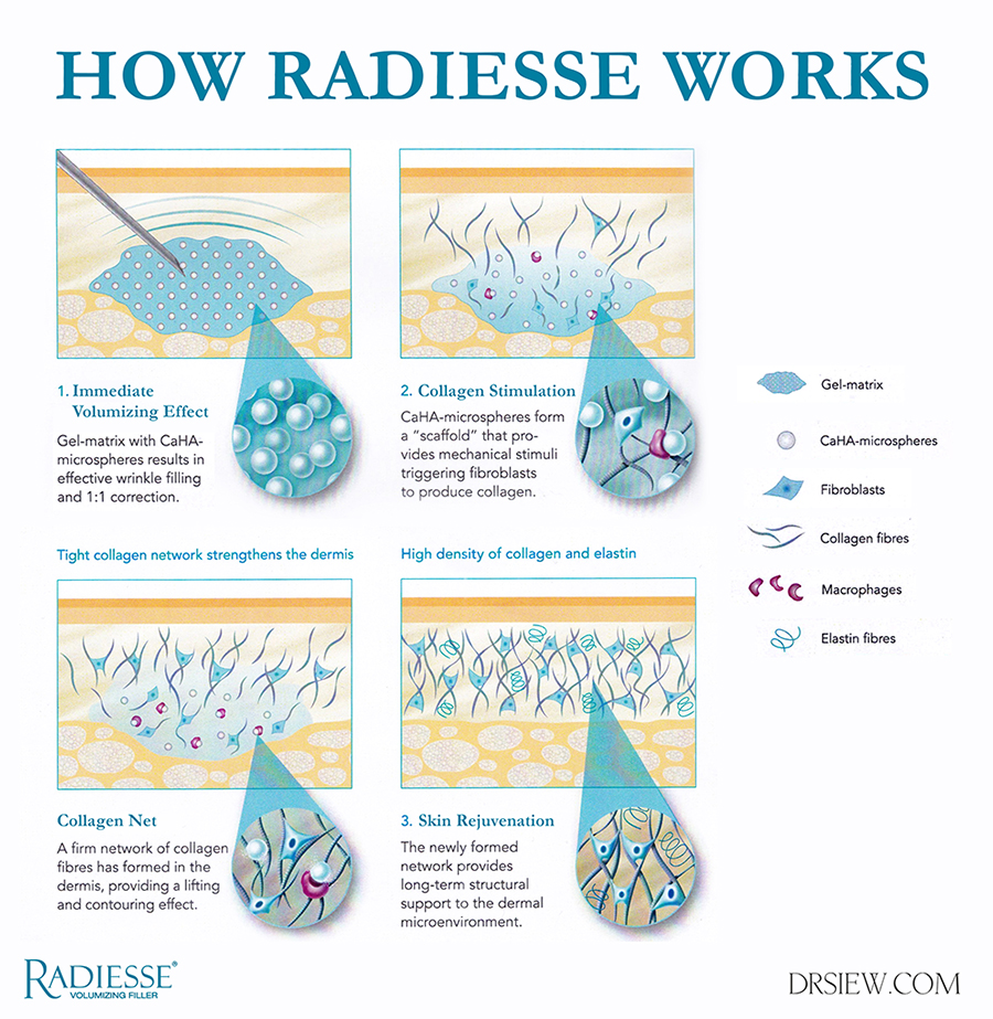 Hoe Radiesse werkt Dr. Siew