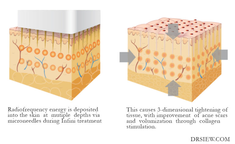 Infini Radiofrequency Microneedling- Effective Acne Scar Treatment ...