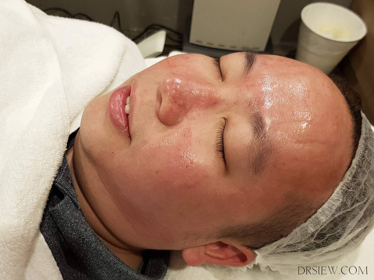Infini downtime redness