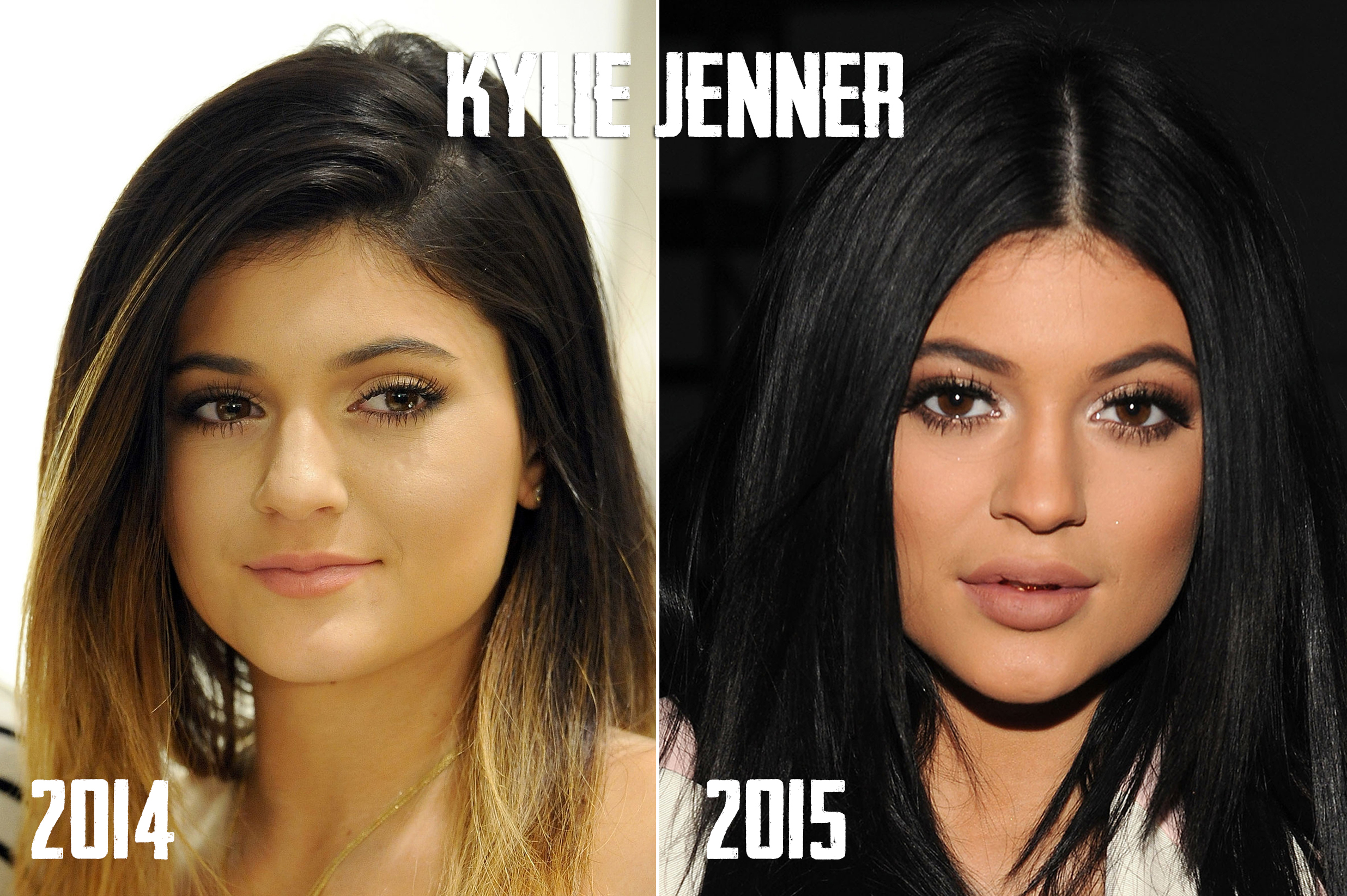 Kylie Jenner Lips Before And After