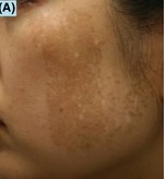 Mottled hypopigmentation