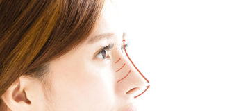 Non Surgical Nose Lift Dr siew