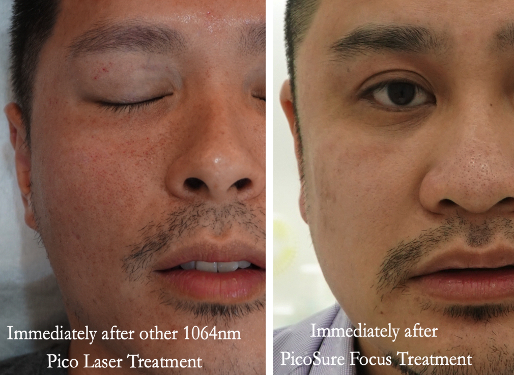 Picosure Laser A Gentler Alternative For Acne Scars Dr Siew