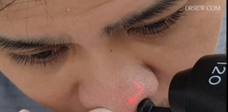 Dr Siew eCo Carbon Dioxide Fractional Resurfacing Laser for Nose Acne Scars