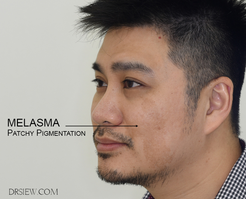 Dr Siew Melasma