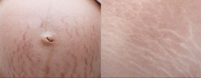 Stretch Marks Prevention And New Treatment Strategies Based On Science Dr 3894