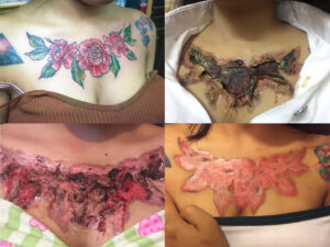 Can tattoos be removed by lasers permanently and without scarring  Quora