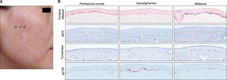 mottled hypopigmentation cause