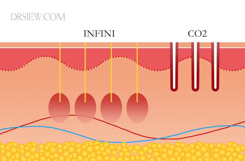 Acne Scars Best Treatment Options Lasers Tca Micro Needling