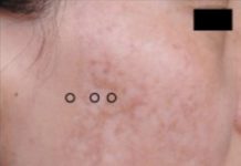 Too Much Laser Toning Could Give You Irreversible Skin Damage Called Mottled Hypopigmentation mottled hypopigmentation