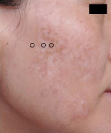 Excessive Laser Treatment Can Lead To Mottled Hypopigmentation