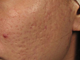 Acne Scars treatment singapore