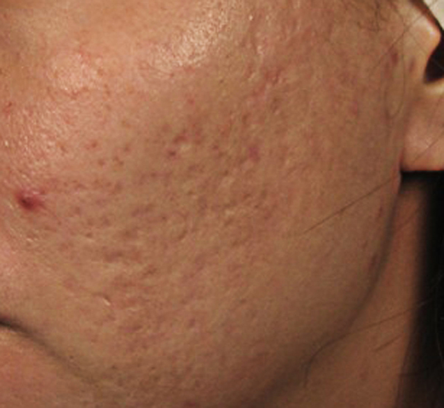 Acne Scars treatment singapore